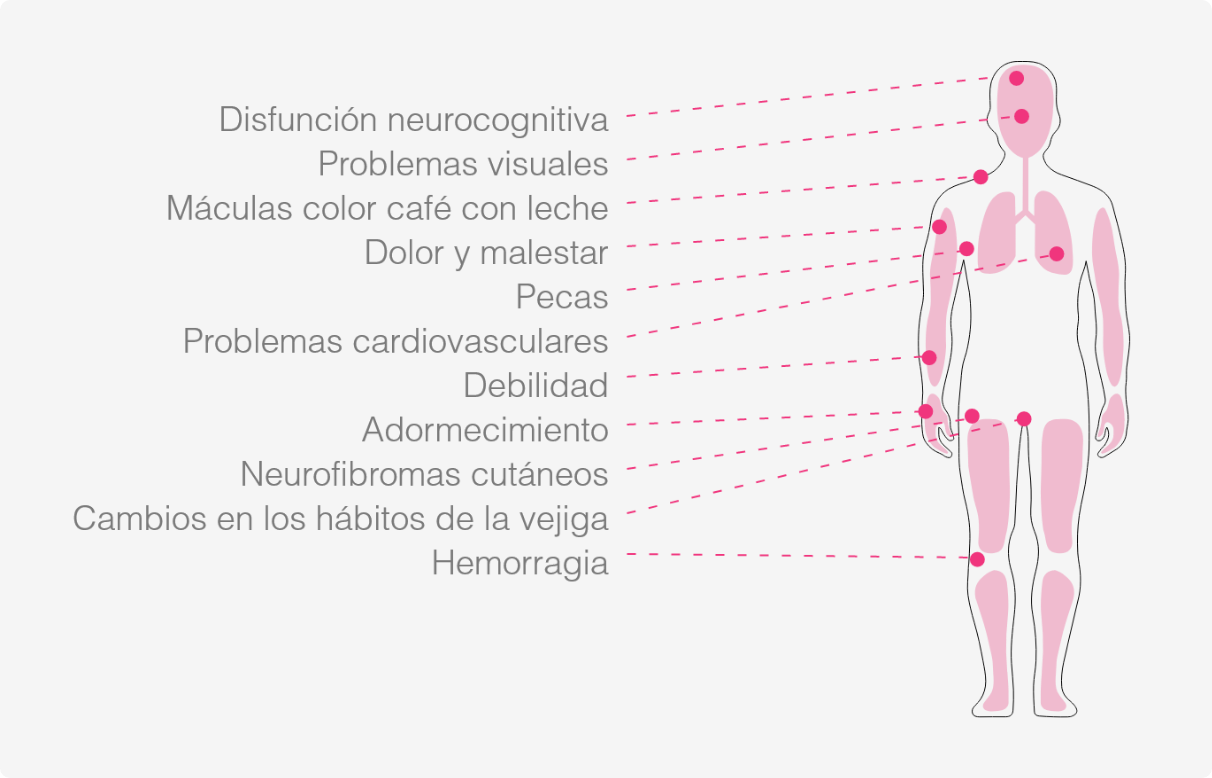 infografia nf1