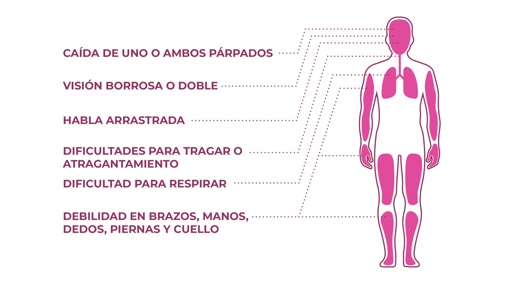 algunos síntomas de la miastenia gravis